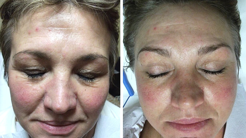 Schluplider-Behandlung (Vorher und Nachher)